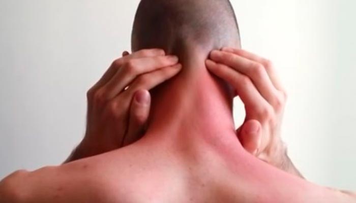 hernia discal medular
