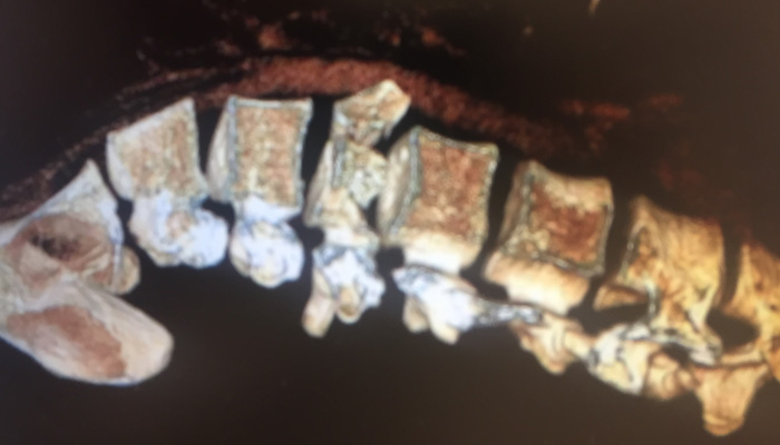 fractura columna vertebral